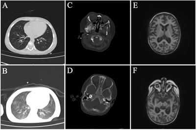 Invasive Fusarium solani infection diagnosed by traditional microbial detection methods and metagenomic next-generation sequencing in a pediatric patient: a case report and literature review
